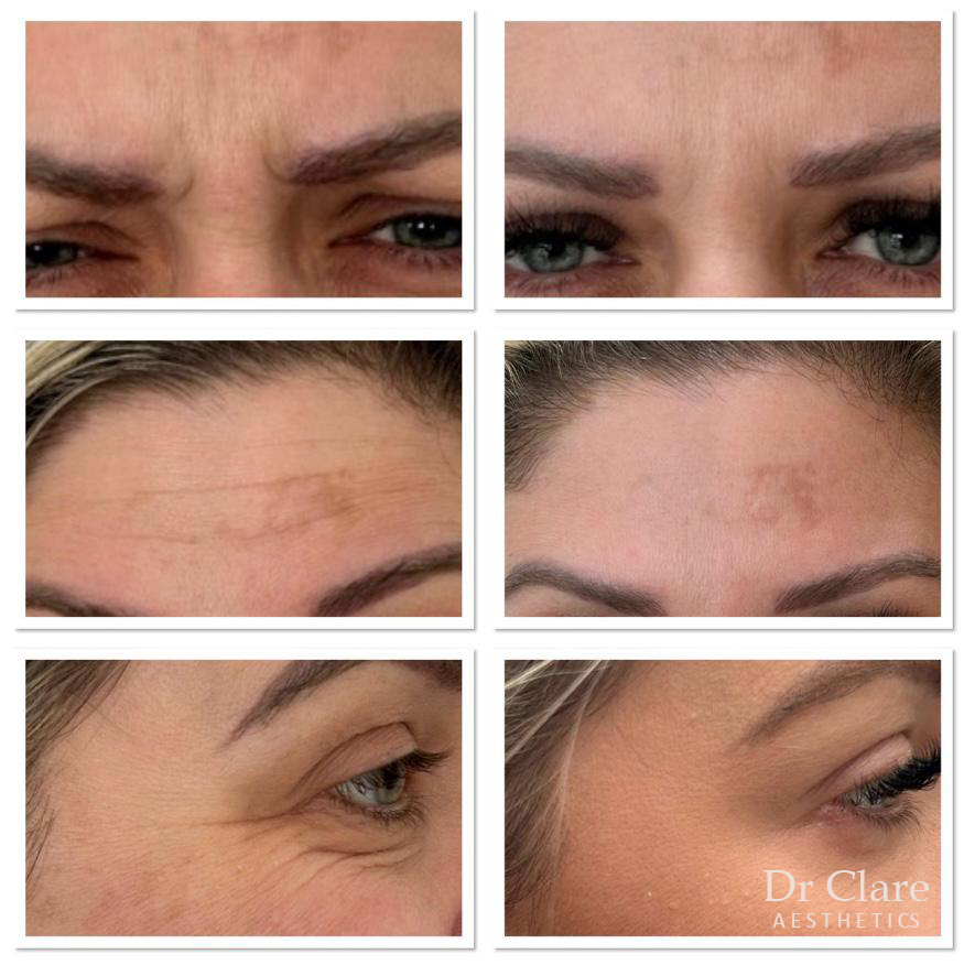 General anti-wrinkle before and after example