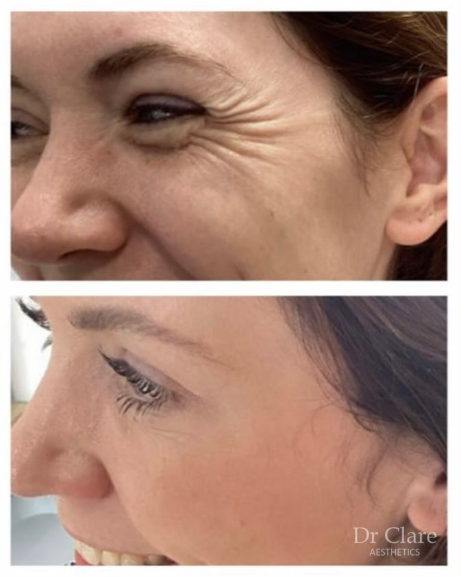 Anti-wrinkle before and after result for crow's feet