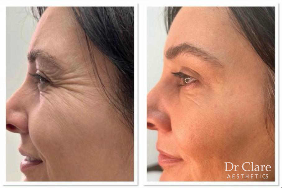 Crow's feet anti-wrinkle before and after