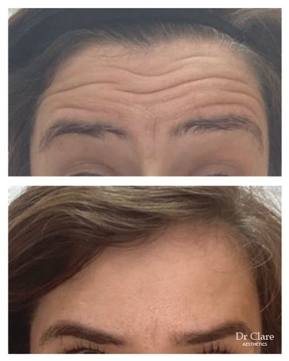 Forehead line smoothing after anti-wrinkle treatment