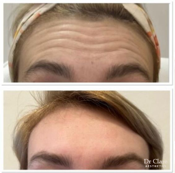 Forehead line improvement after treatment