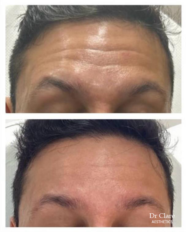 Forehead anti-wrinkle result example
