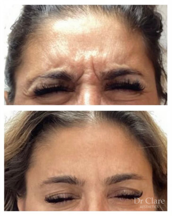 Frown lines before and after anti-wrinkle treatment