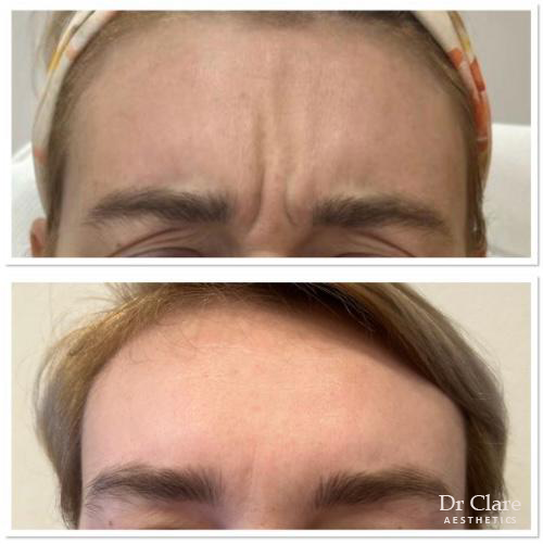 Frown lines anti-wrinkle result example