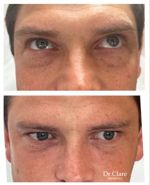 Dermal filler before and after result