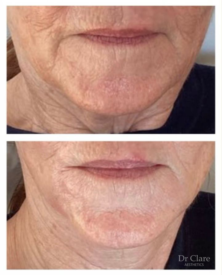 Dermal filler facial balancing result