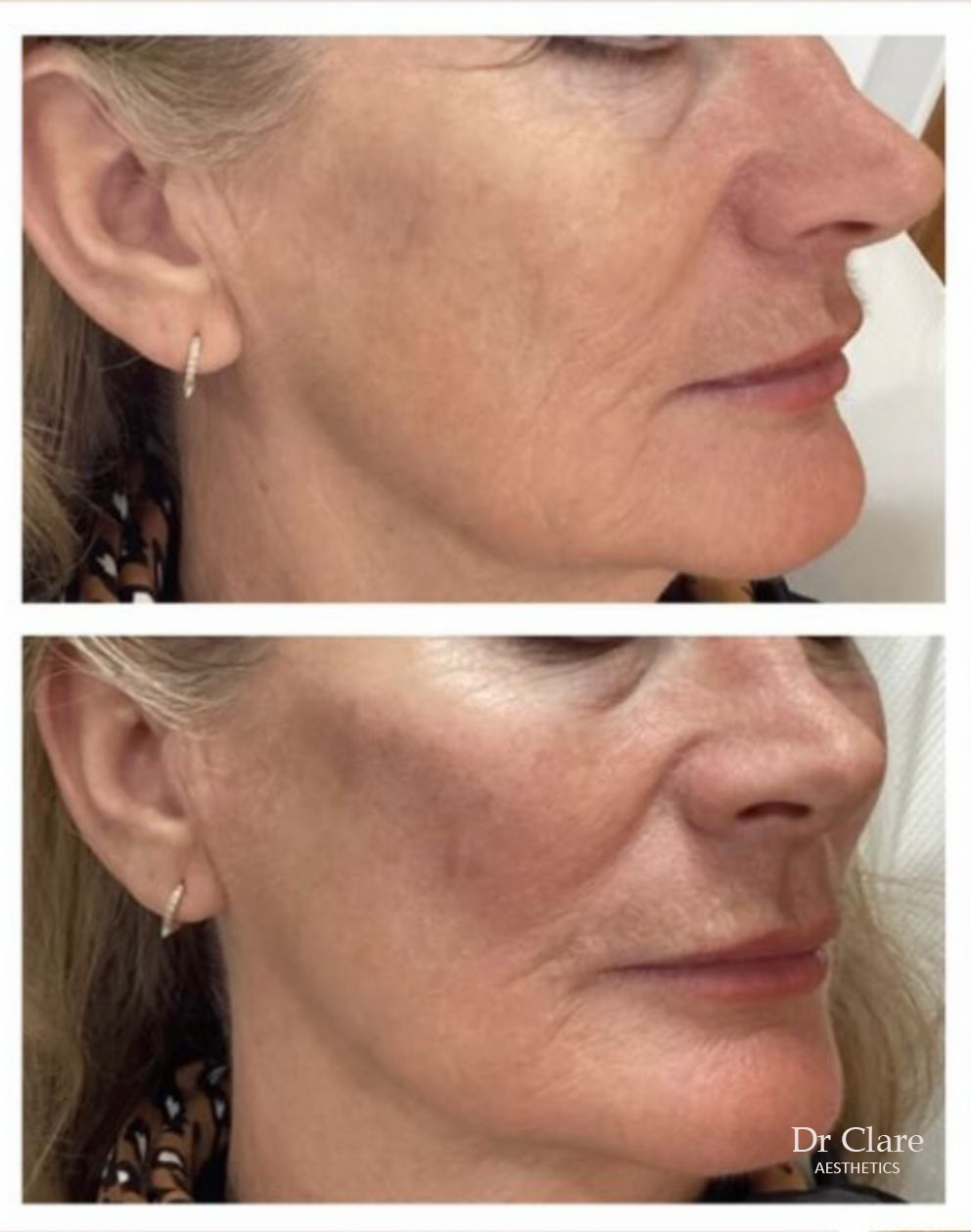 Cheek filler before and after result
