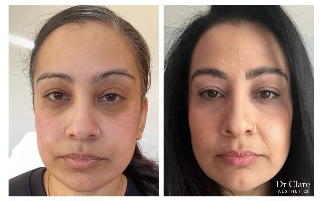 Cheek enhancement before and after