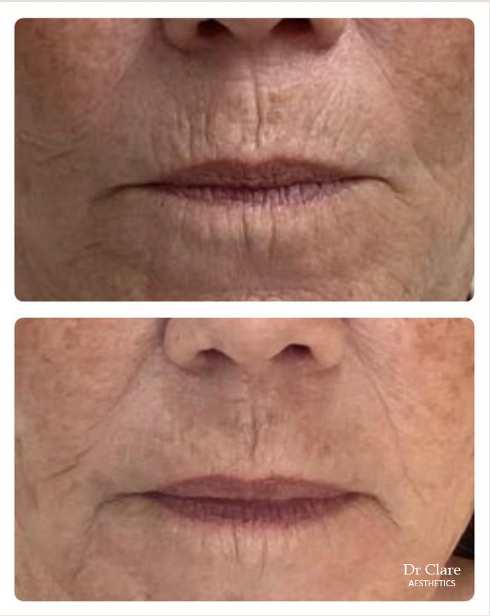 General dermal filler before and after example