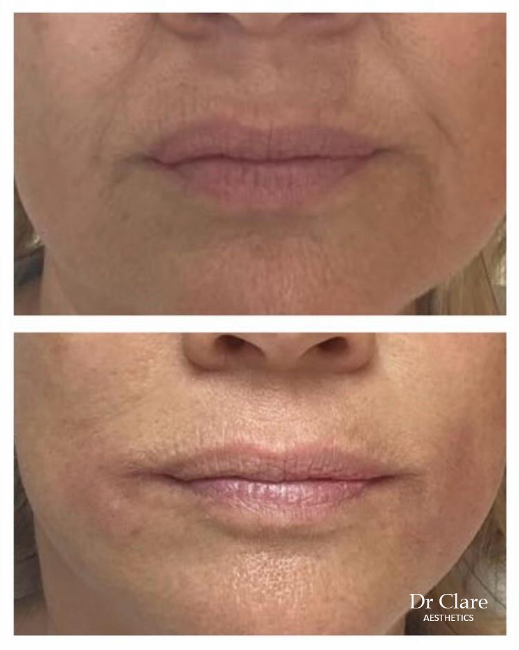Marionette lines filler before and after