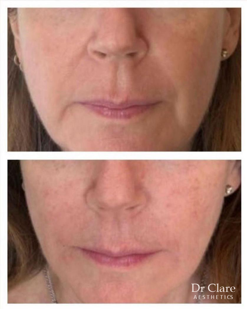 Facial contouring filler before and after
