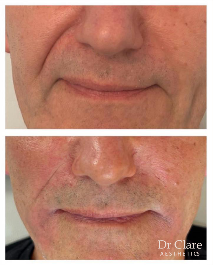 Nasolabial fold filler result