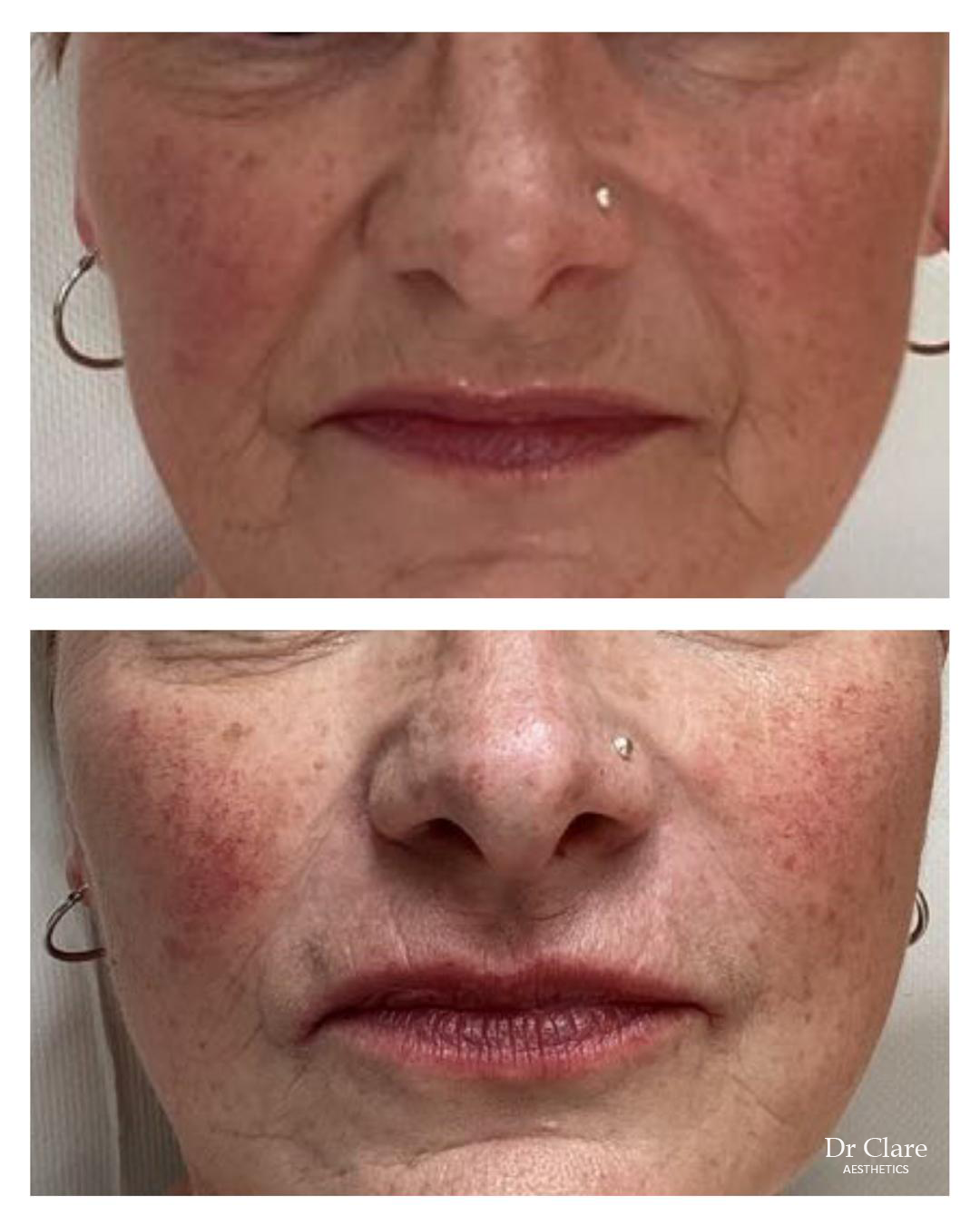 Nasolabial line softening with dermal filler