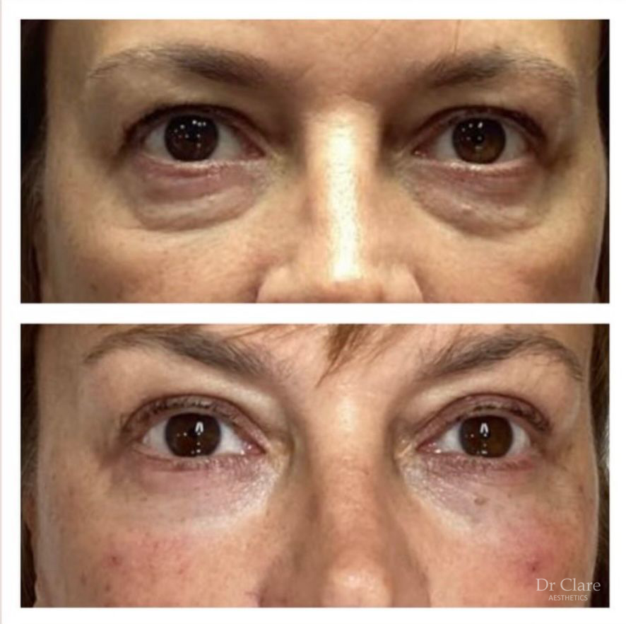 Tear trough filler result example