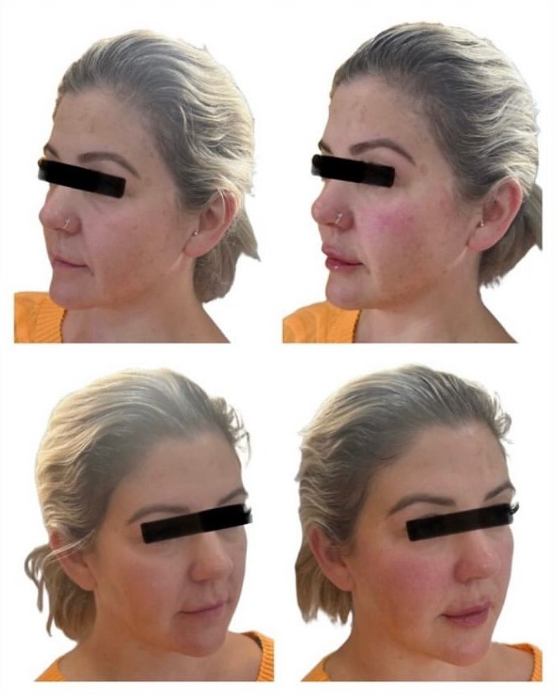 Lip and lower face filler side profile result
