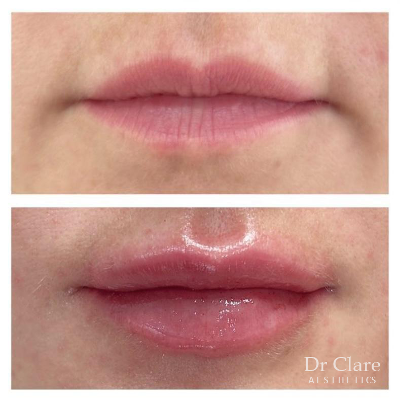 Lip filler result with subtle volume increase