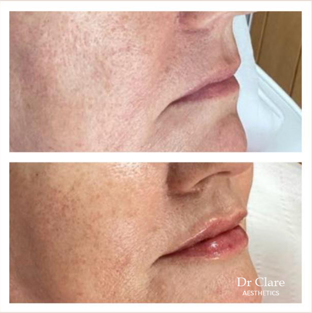 Lip enhancement before and after side-by-side