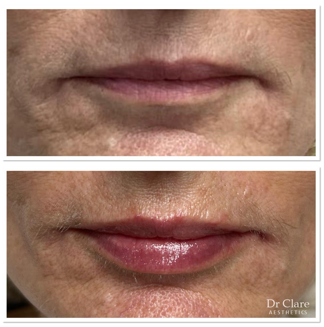 Lip enhancement result with balanced shape
