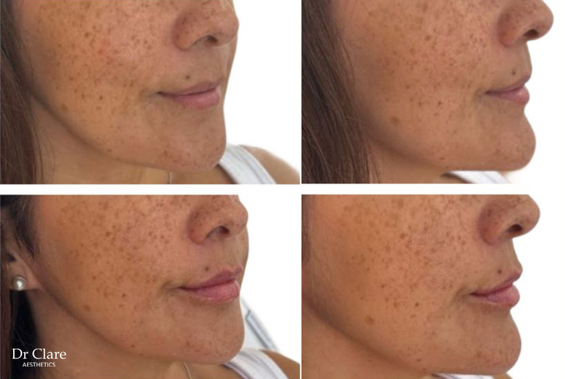 Expanded lip filler before and after