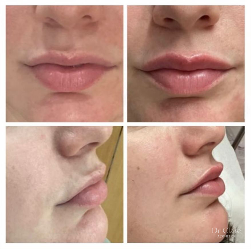 Lip enhancement before and after result