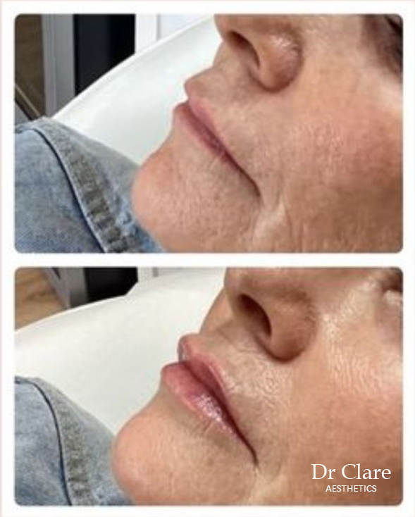 Lip enhancement symmetry improvement result