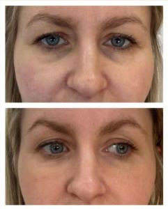 Tear trough treatment result