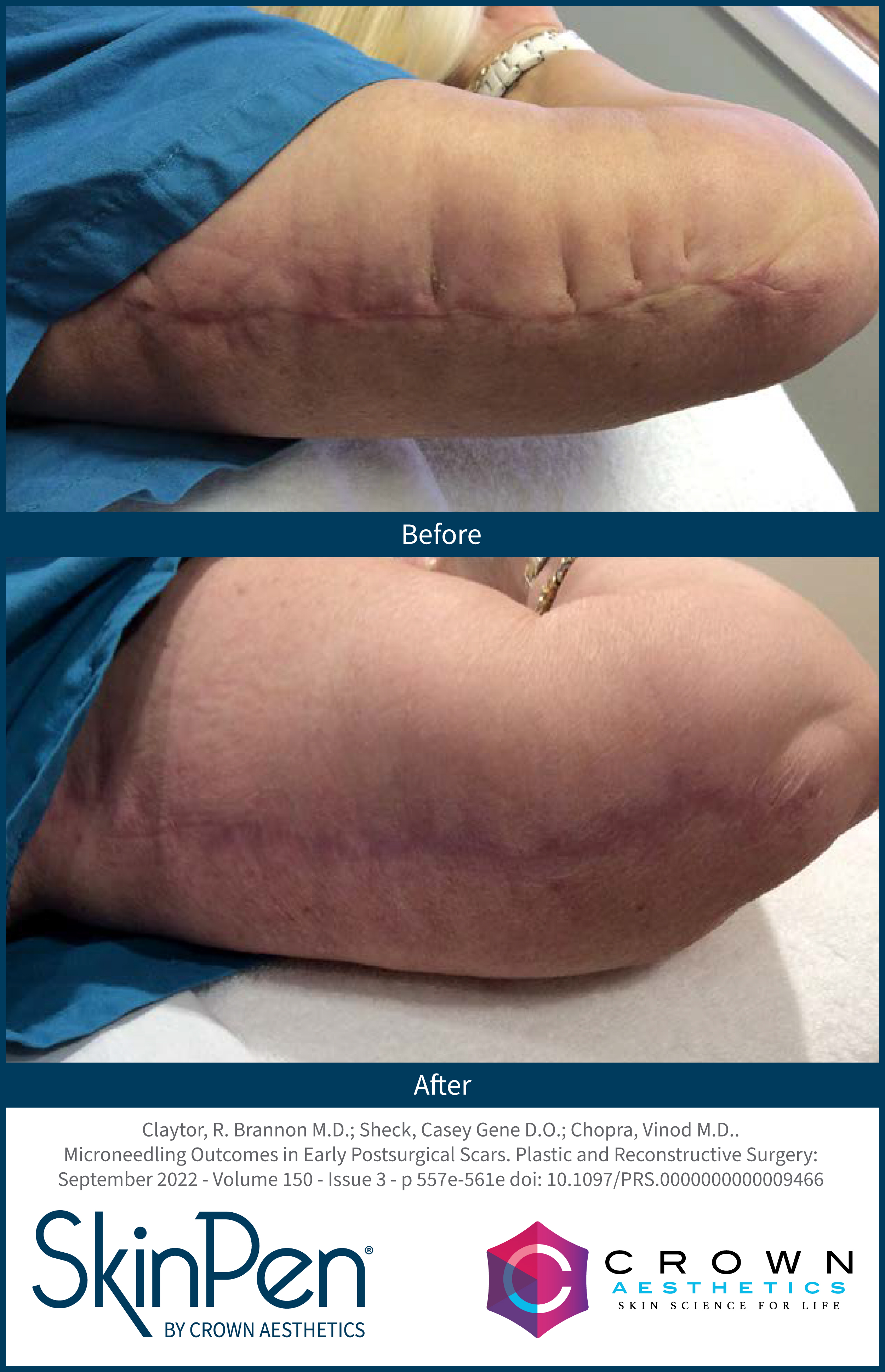 SkinPen surgical arm scar result