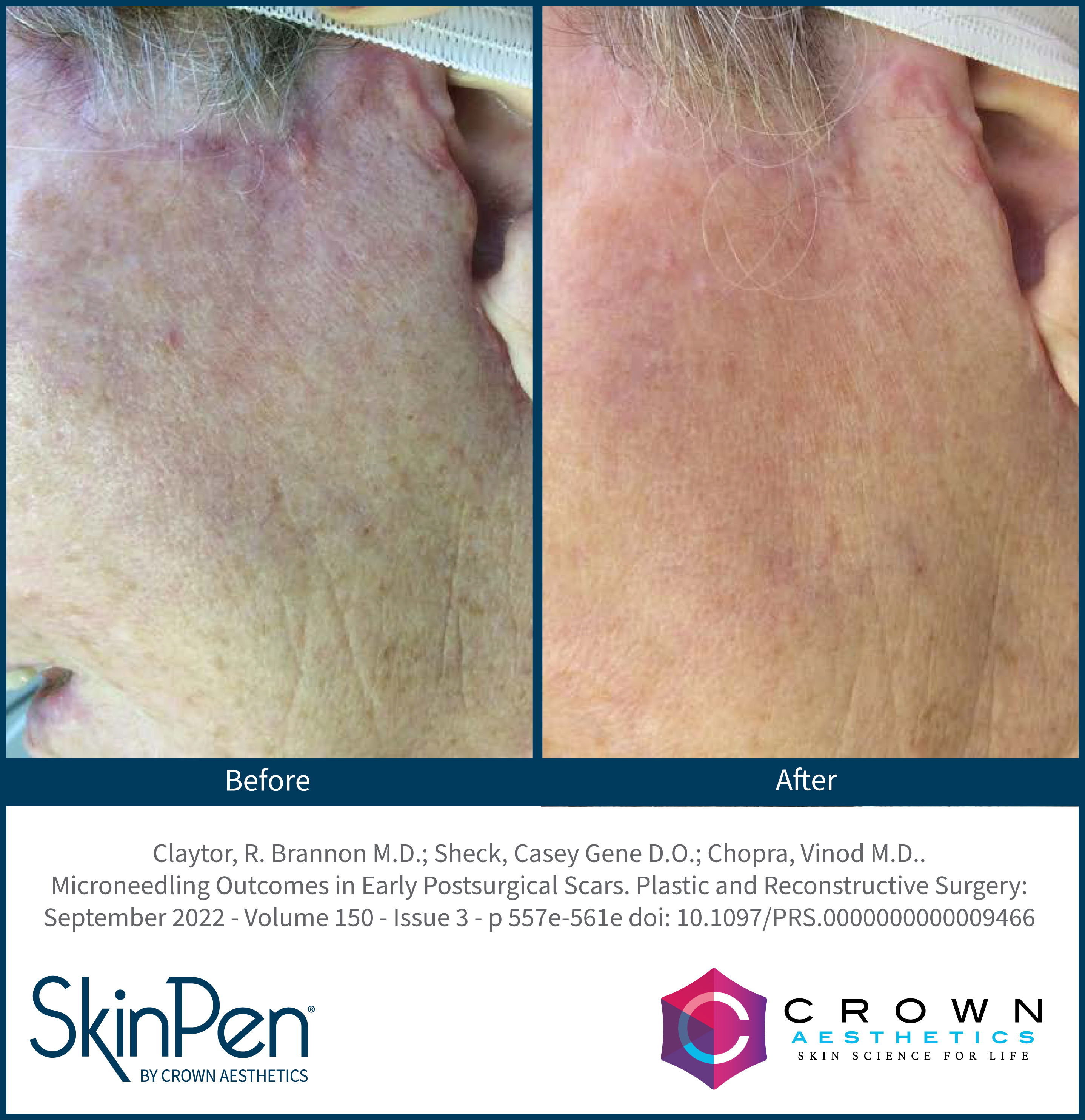 SkinPen facelift scar result vertical comparison