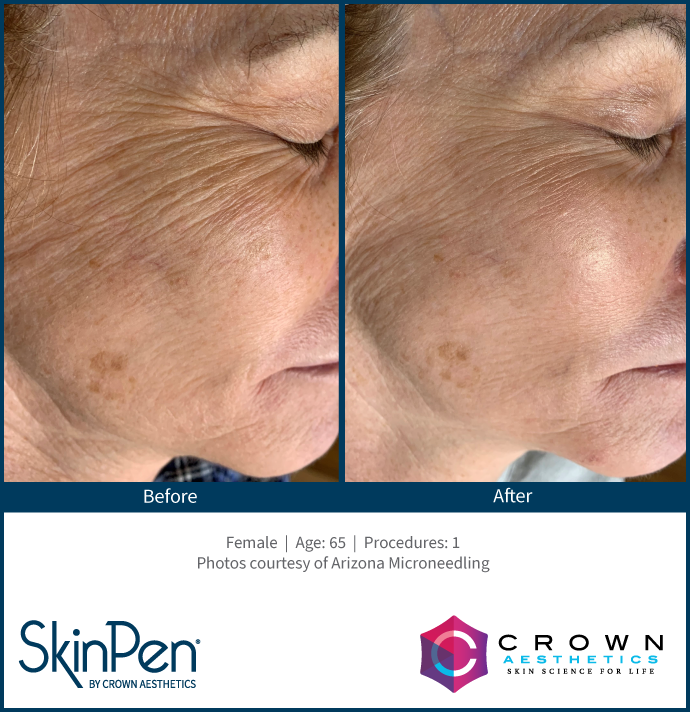 SkinPen facial rejuvenation example