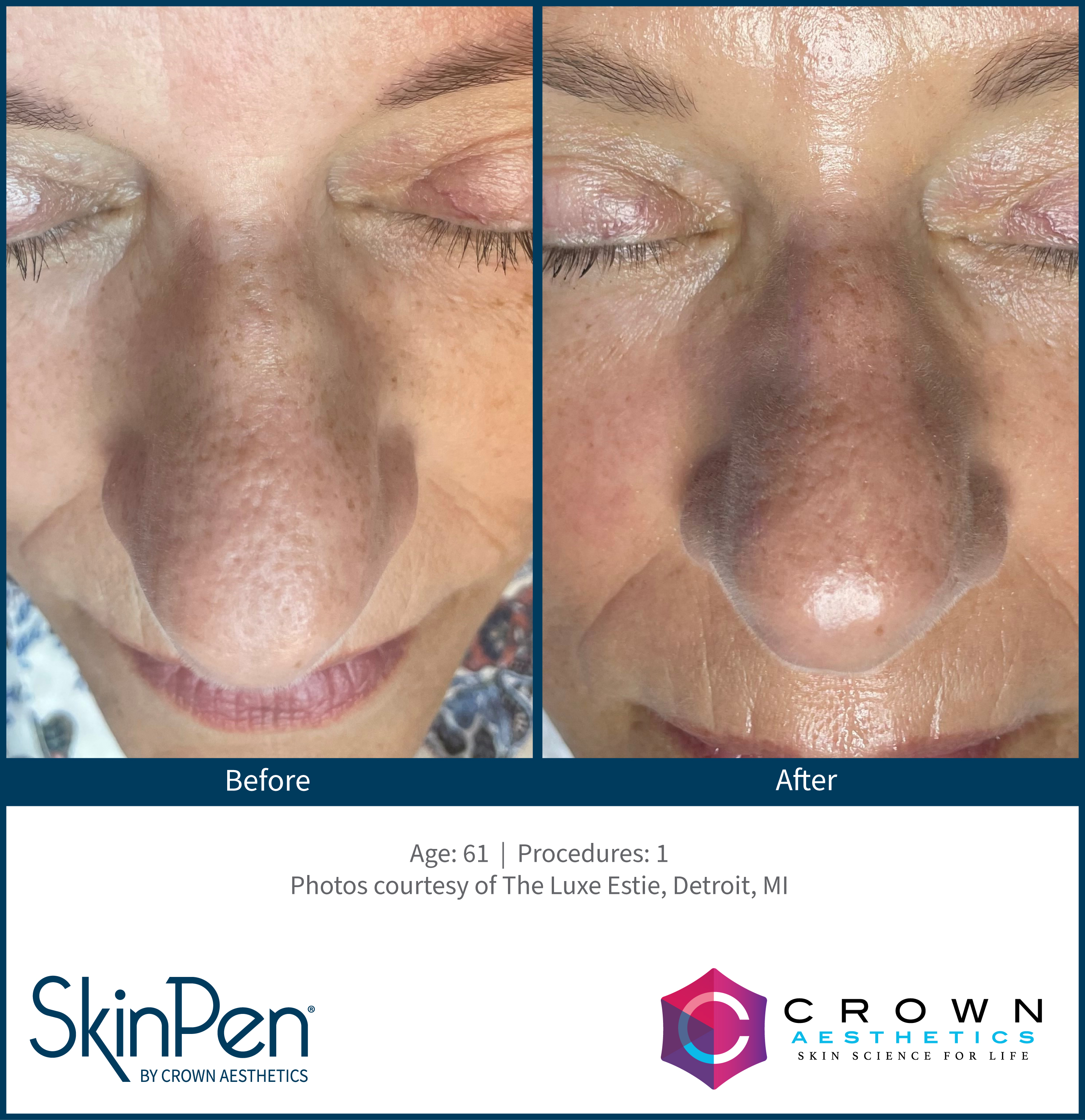 SkinPen rejuvenation before and after result