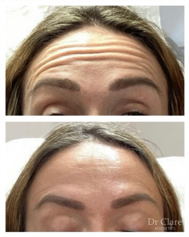 Anti-wrinkle before and after