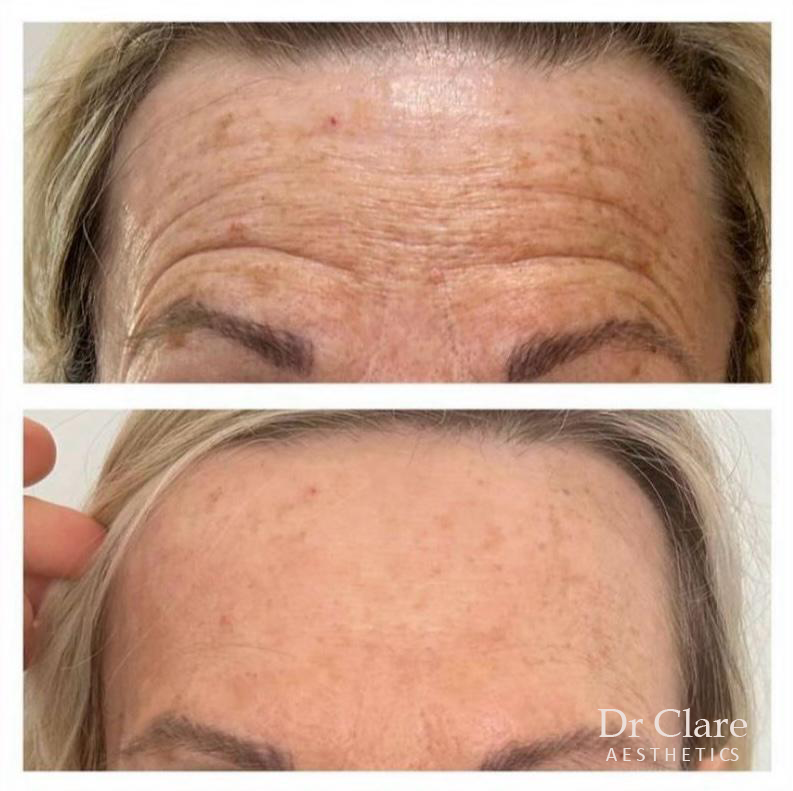 before and after Forehead Line treatment