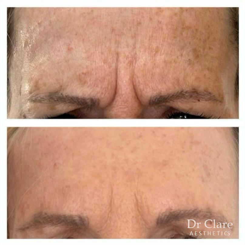 Anti-wrinkle before and after