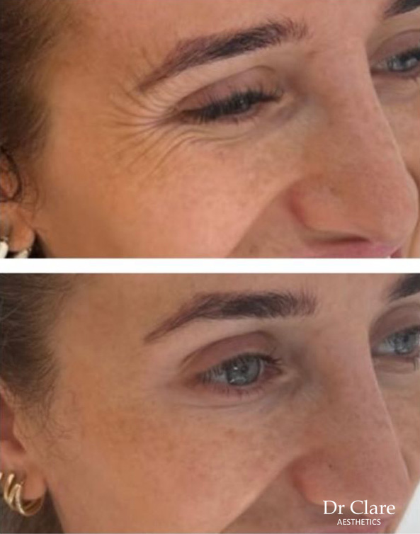 Anti-wrinkle crows feet before and after