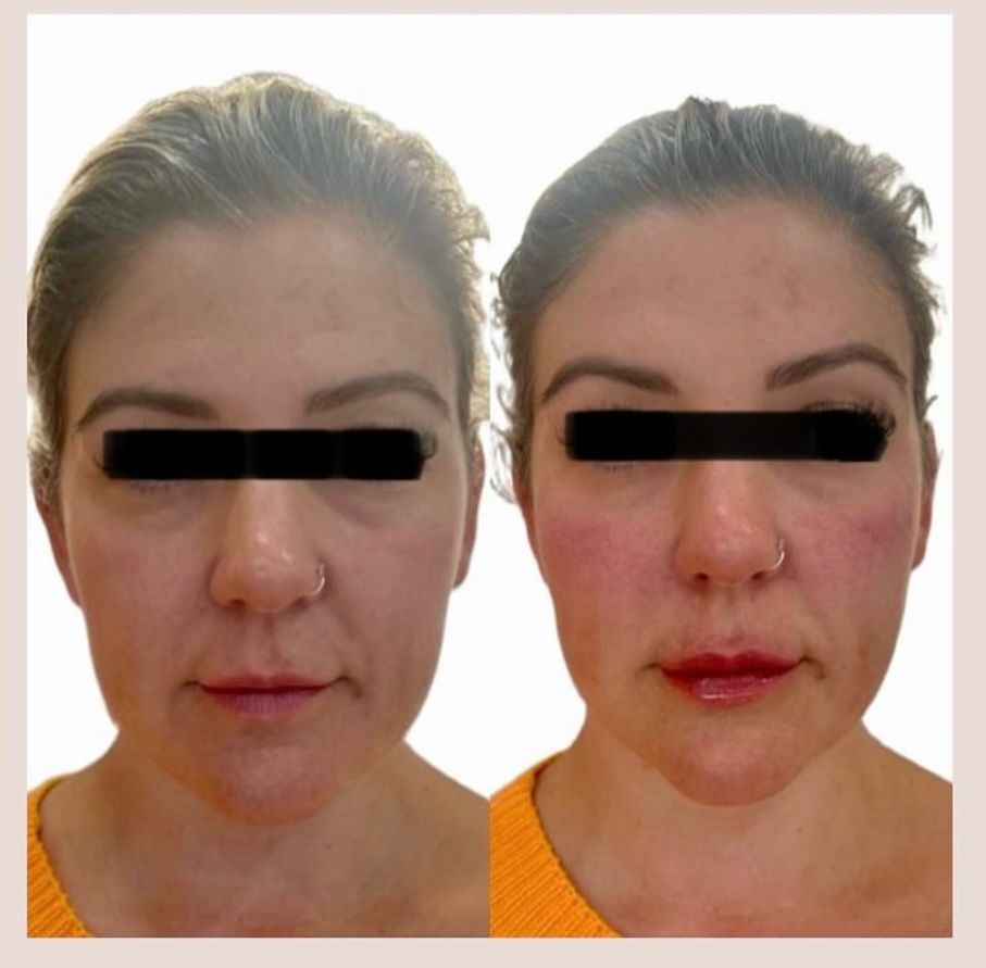 before and after cheek treatment