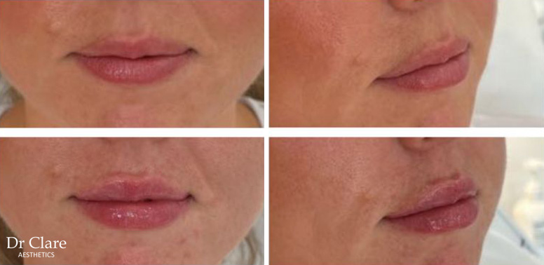 Lips before and after
