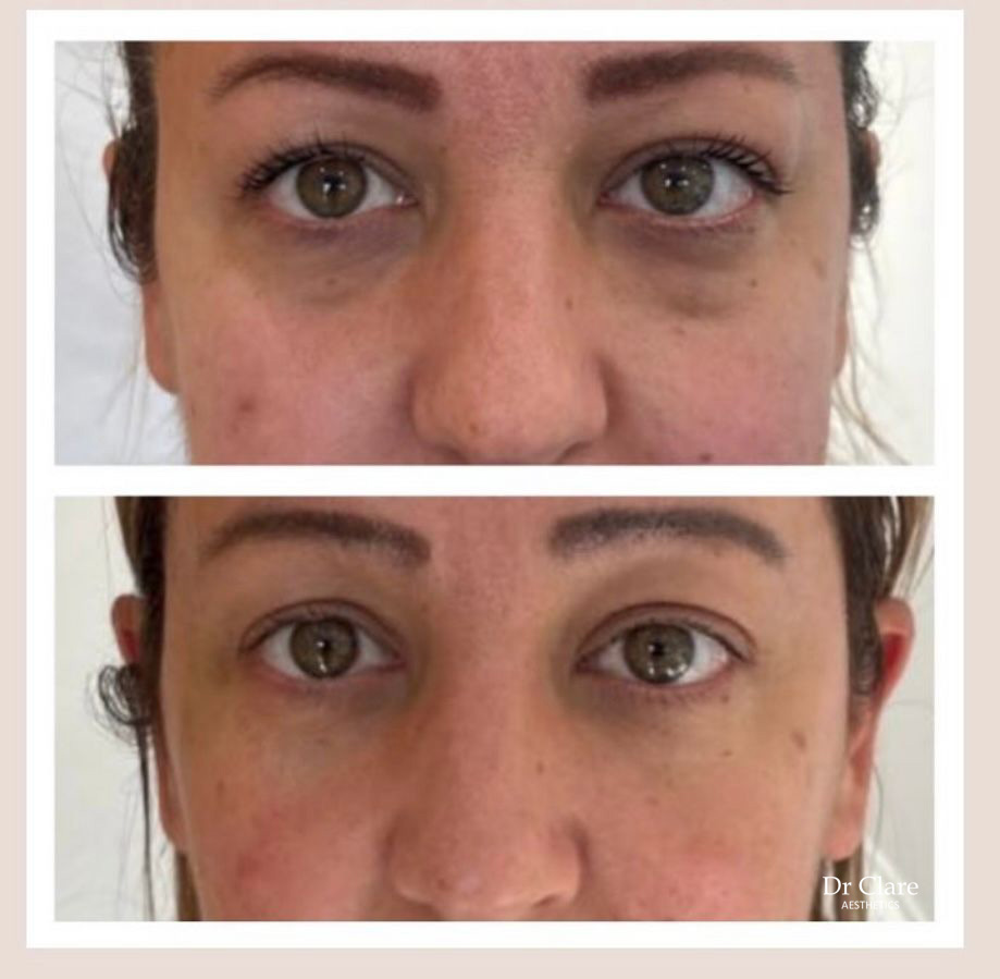 Dermal filler tear drop before and after