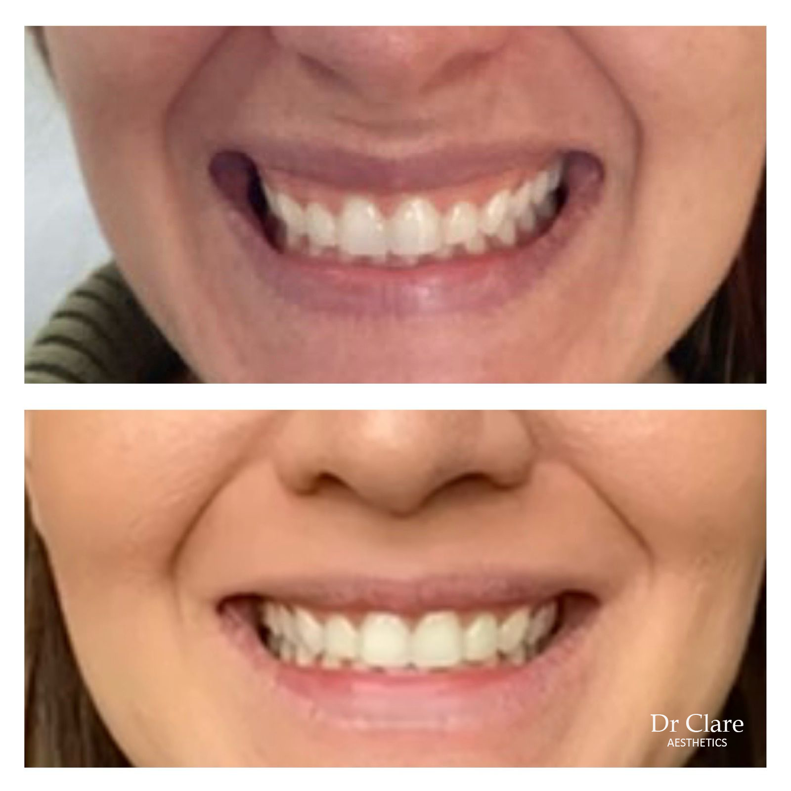 before and after Forehead Line treatment