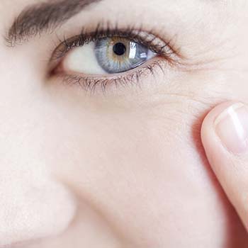 Crows feet