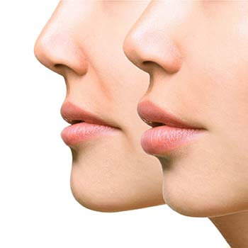 donwturned mouth